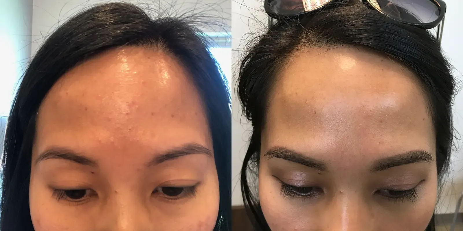 Acne, patient 1, photo 1 of 4: before and after