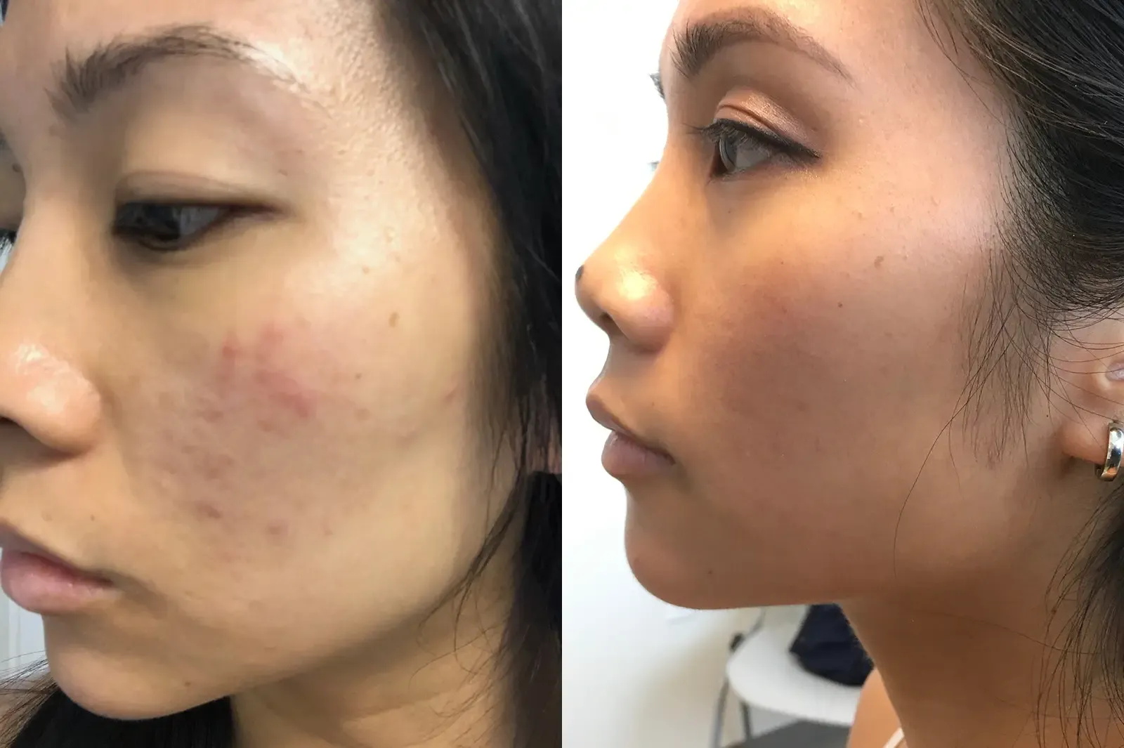 Acne, patient 1, photo 3 of 4: before and after