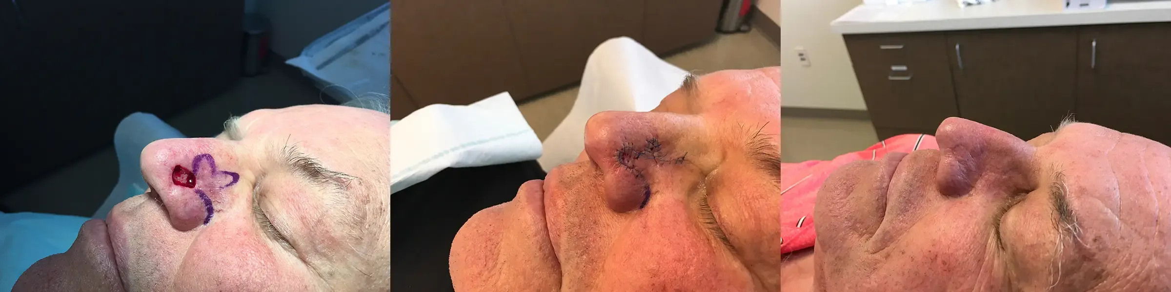 Mohs Surgery, patient 10: before and after