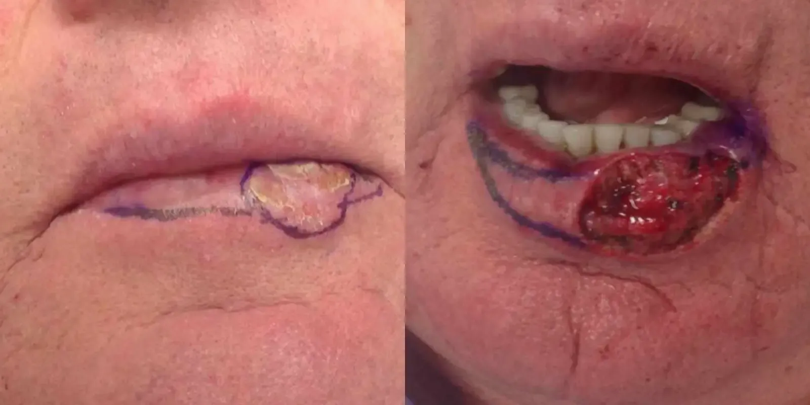 Mohs Surgery, patient 11, photo 1 of 2: before and after