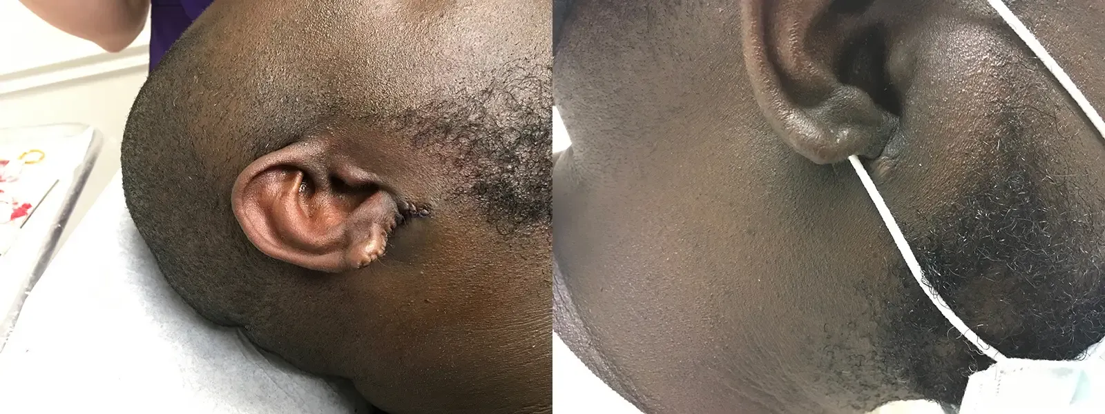 Keloid Excision, patient 12, photo 2 of 3: before and after