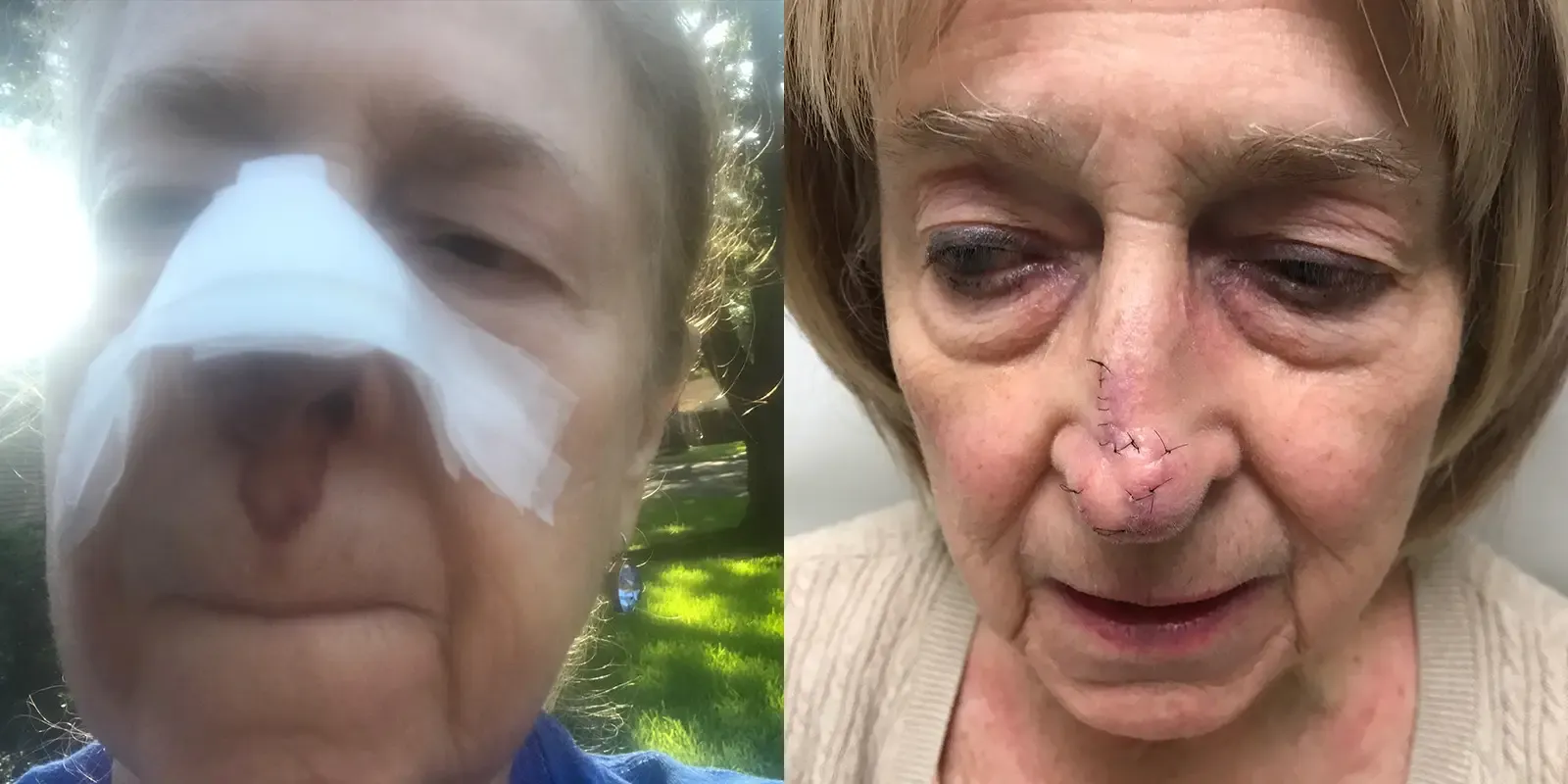 Mohs Surgery, patient 13, photo 1 of 2: before and after