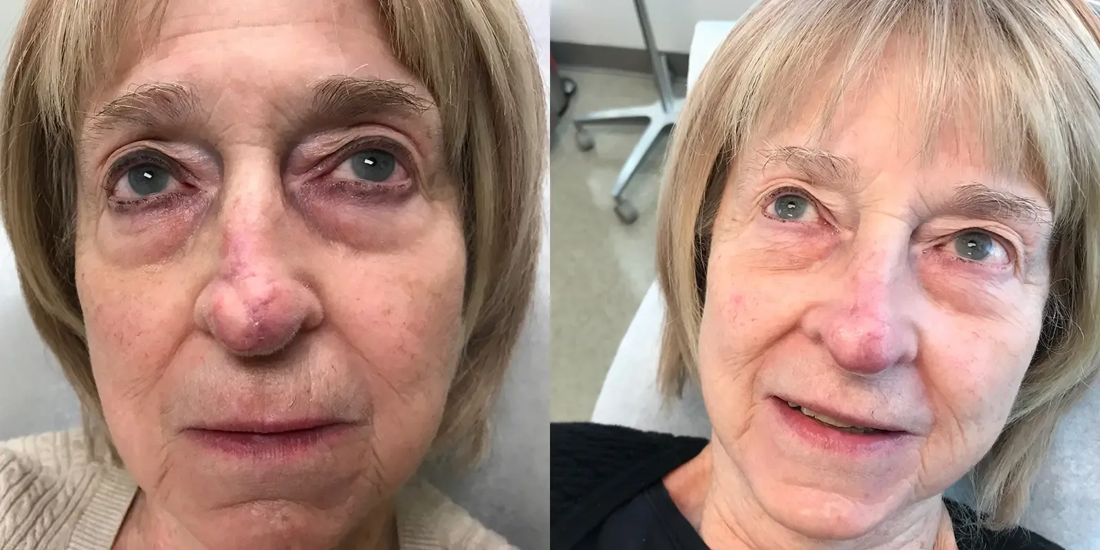 Mohs Surgery, patient 13, photo 2 of 2: before and after