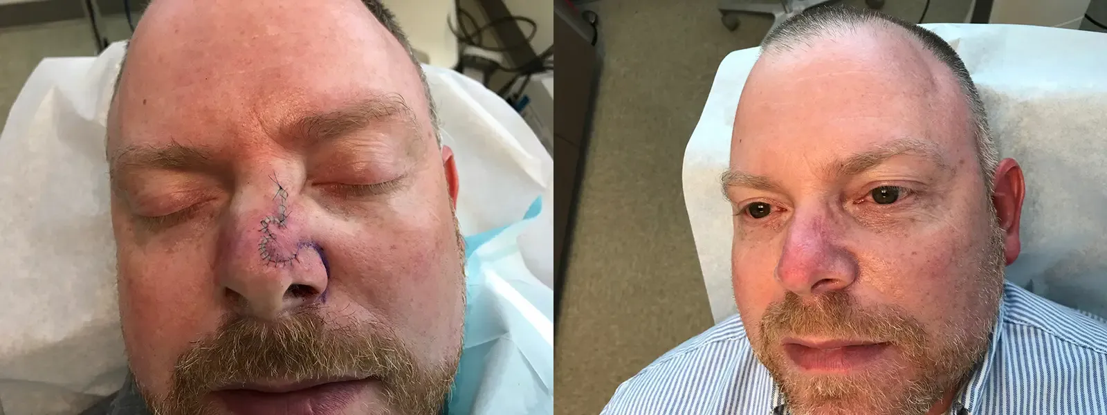 Mohs Surgery, patient 14, photo 2 of 3: before and after