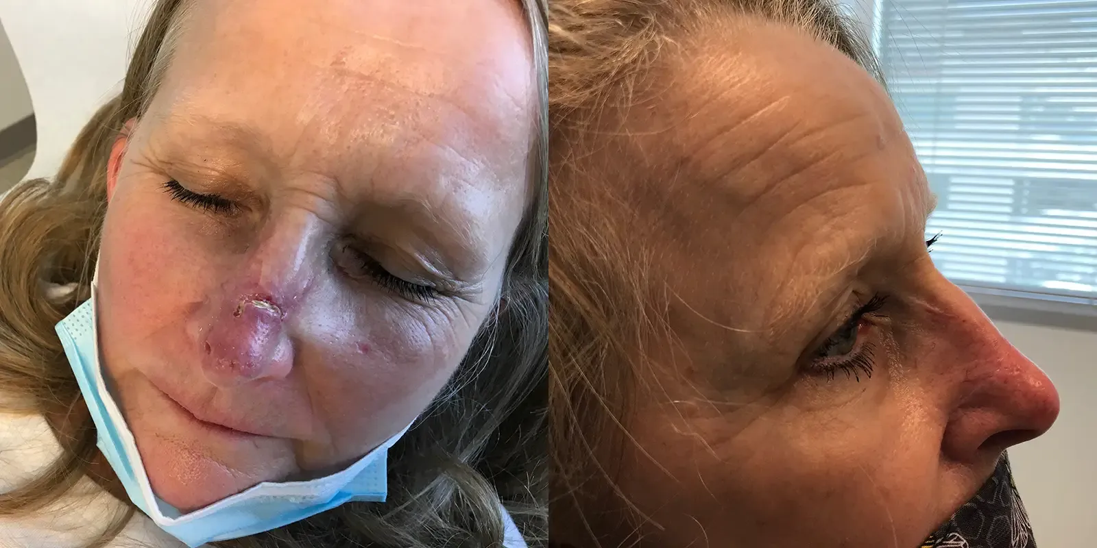 Mohs Surgery, patient 15, photo 2 of 3: before and after