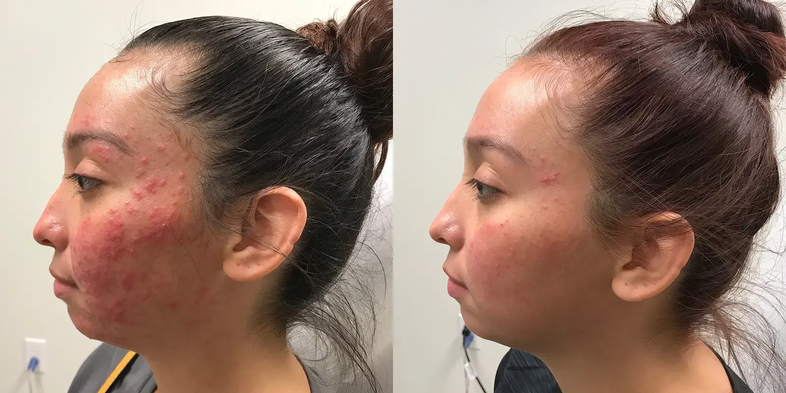 Acne, patient 2, photo 3 of 3: before and after