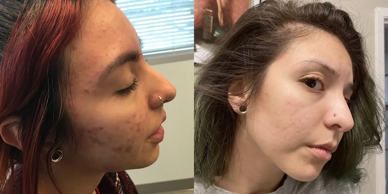 Acne, patient 4: before and after