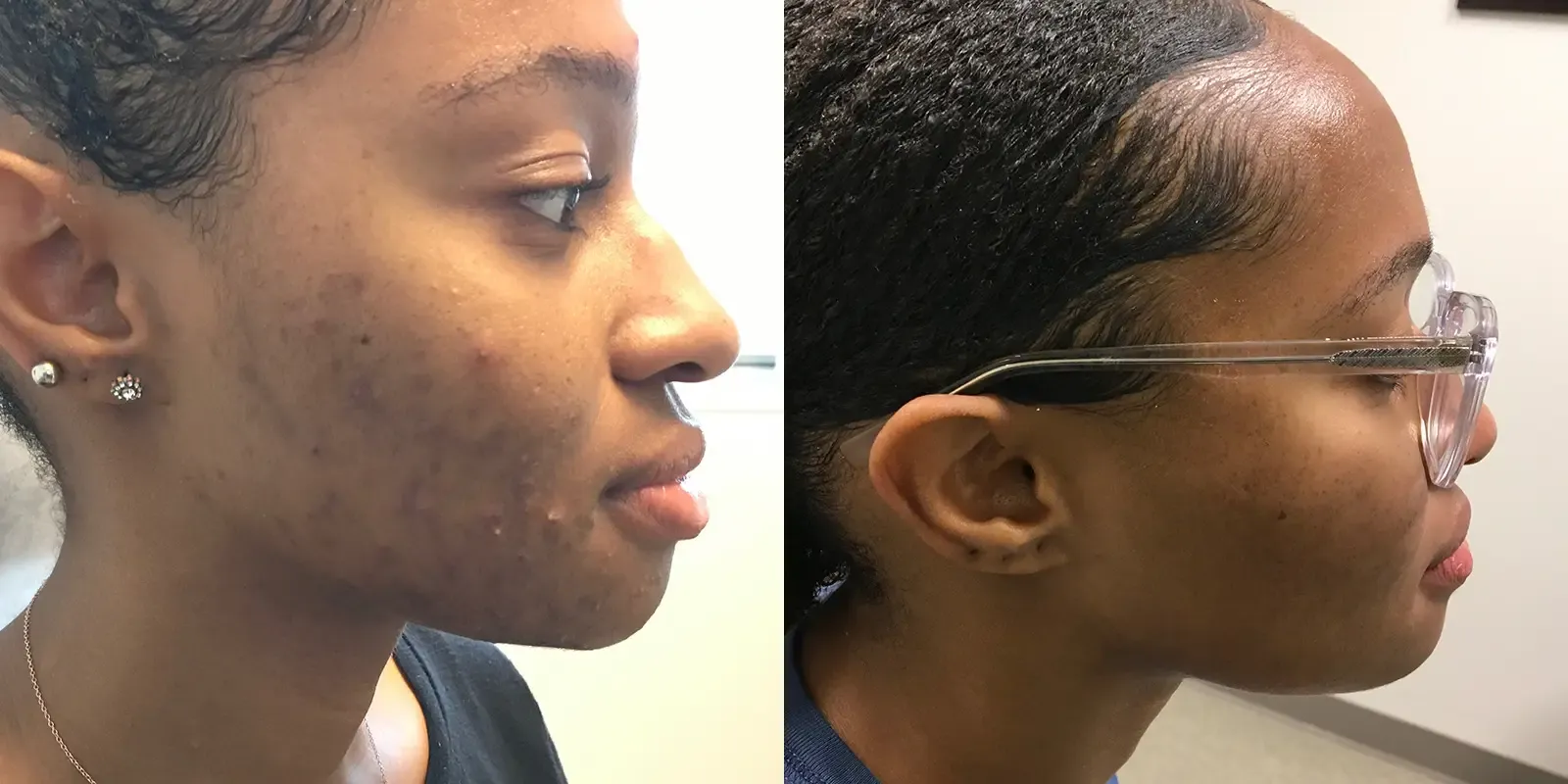 Acne, patient 5, photo 1 of 2: before and after
