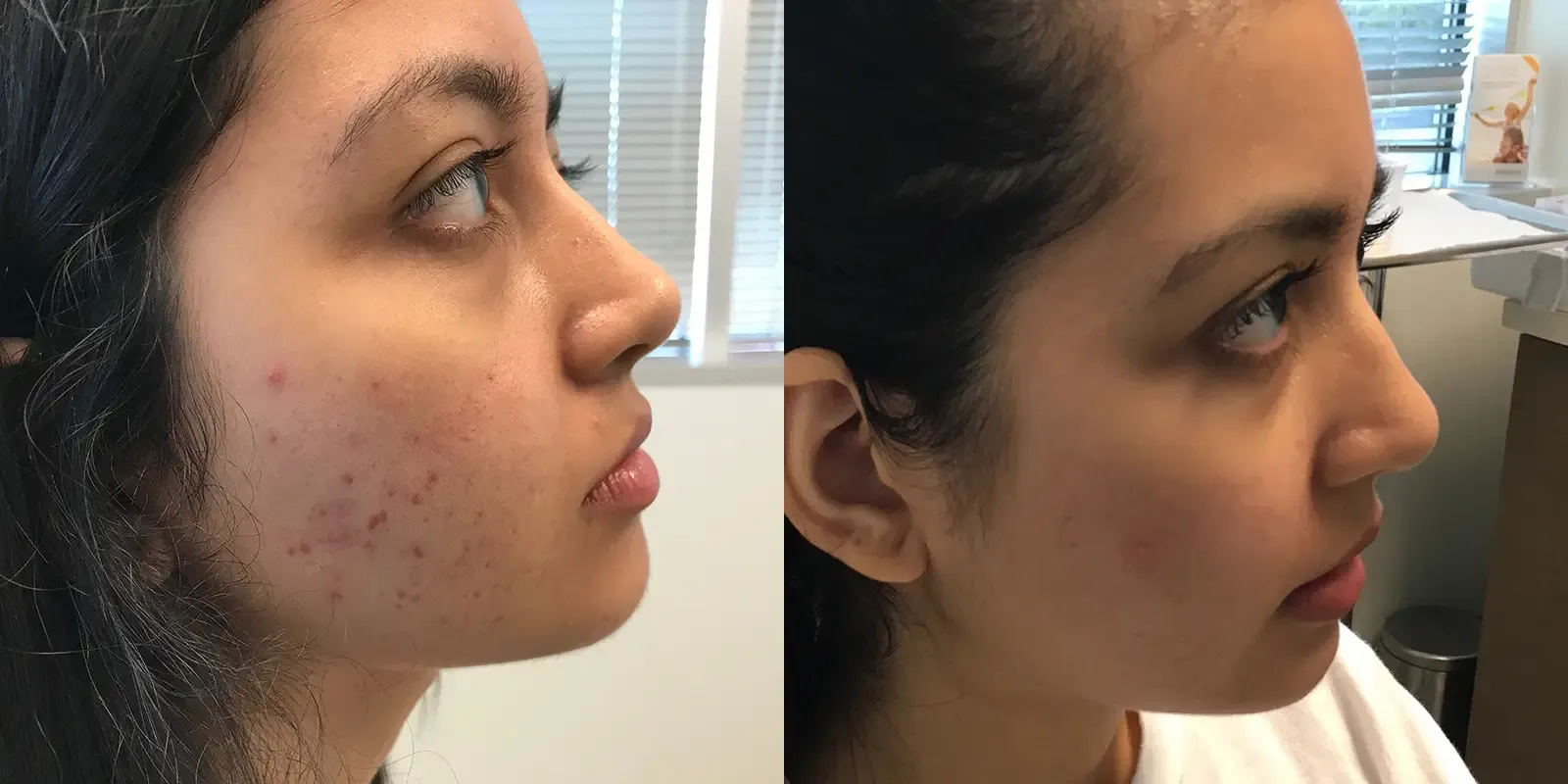 Acne, patient 7, photo 1 of 2: before and after