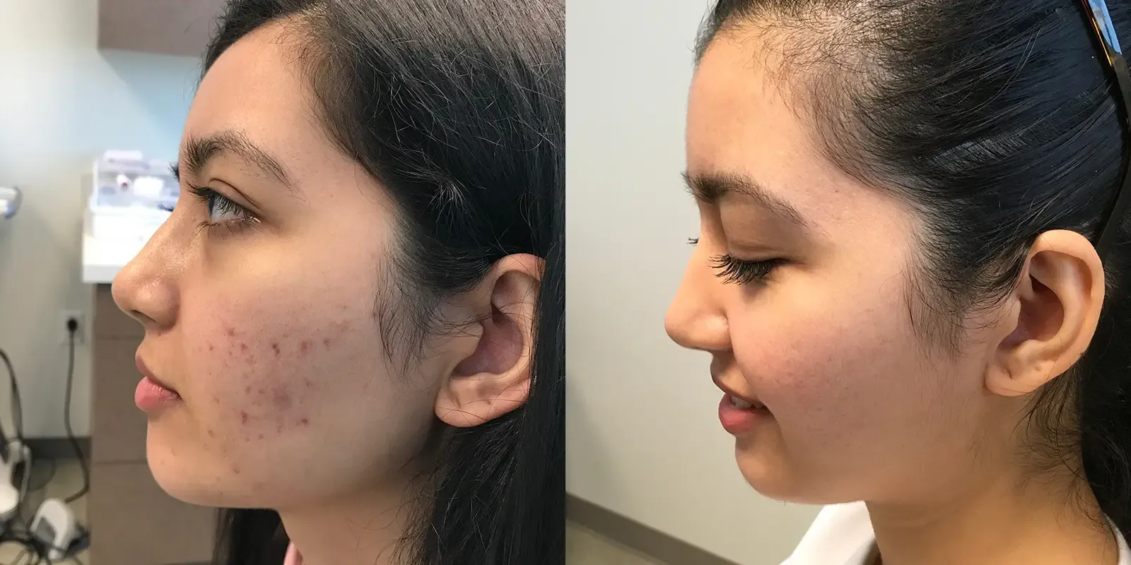 Acne, patient 7, photo 2 of 2: before and after