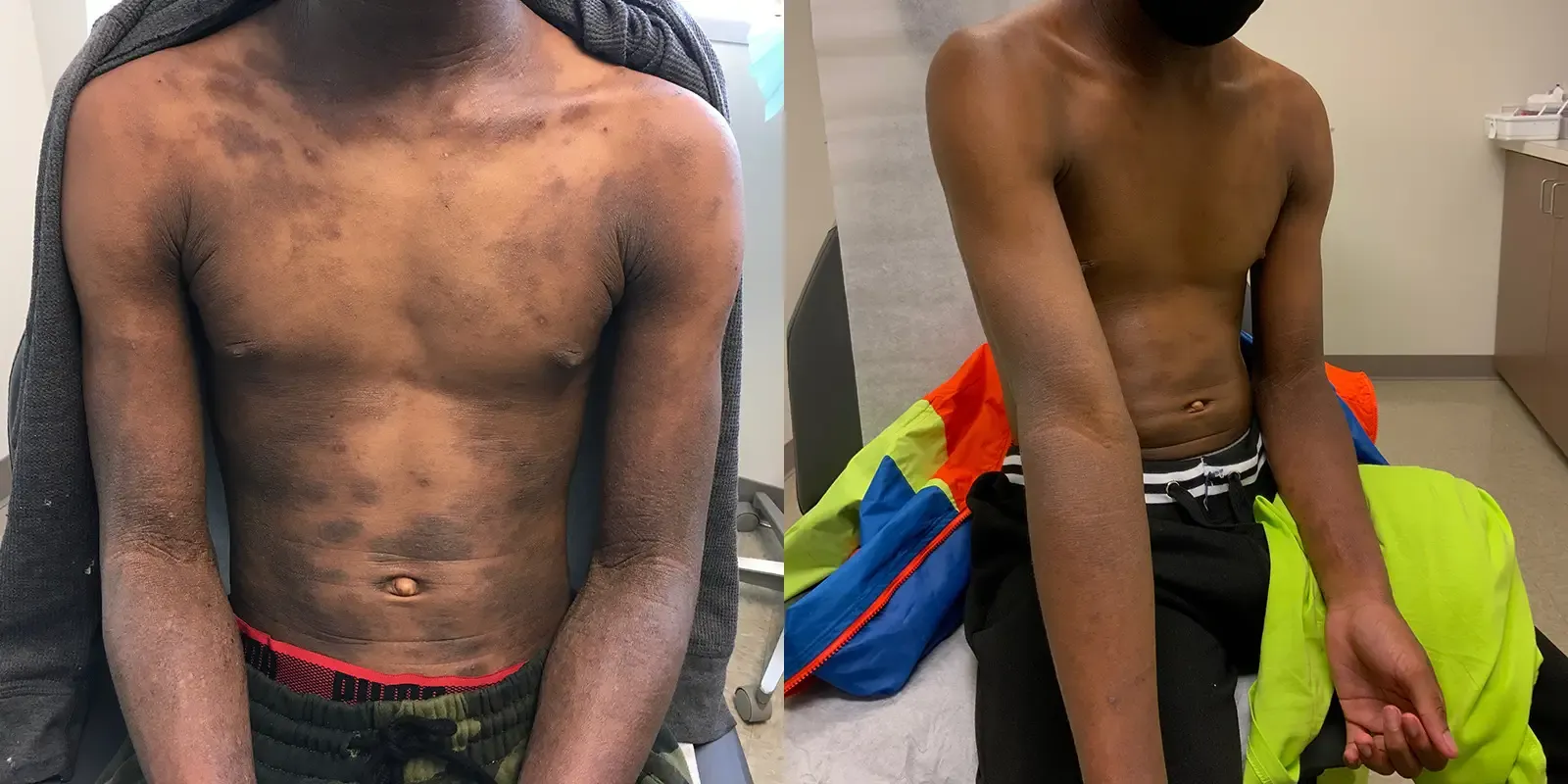 Rash, patient 8: before and after