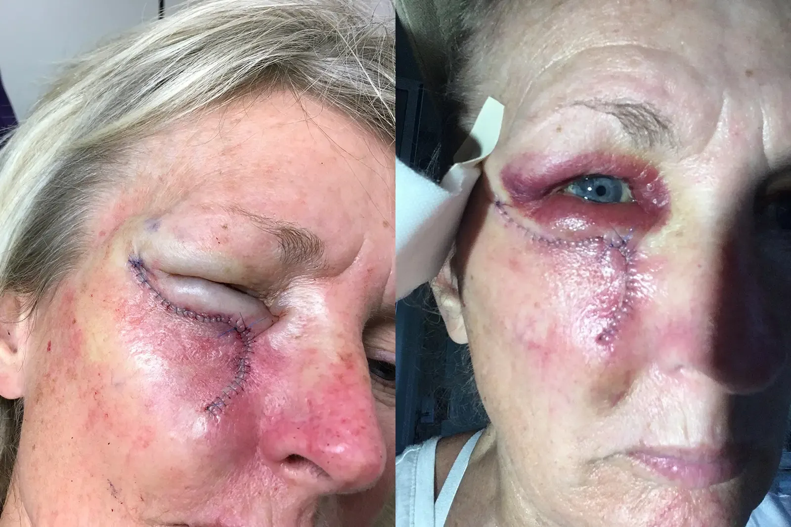 Mohs Surgery, patient 9, photo 2 of 5: before and after