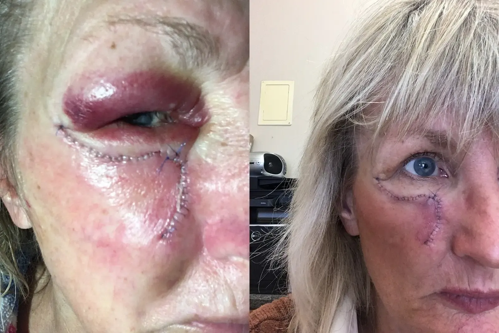 Mohs Surgery, patient 9, photo 3 of 5: before and after