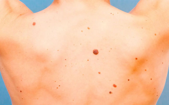 moles