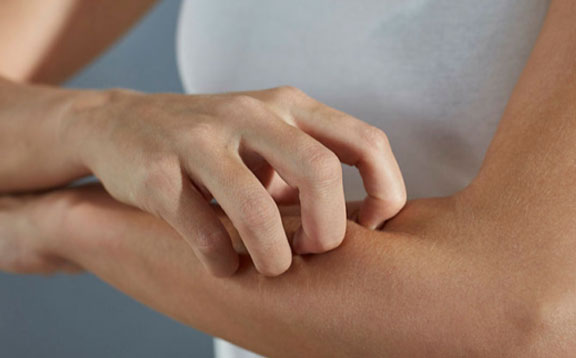 psoriasis