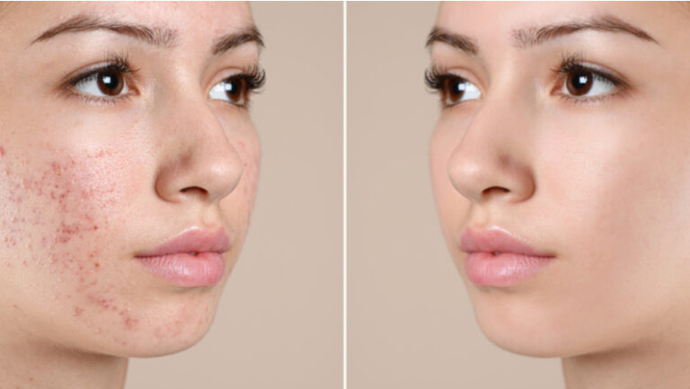 acne extraction