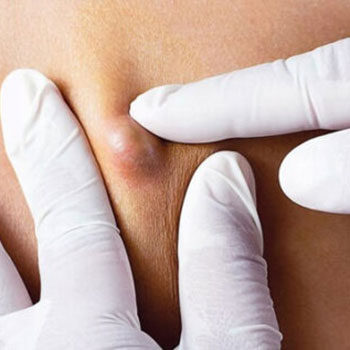 cysts