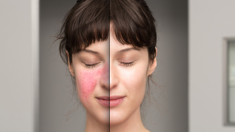 Best Treatment for Rosacea