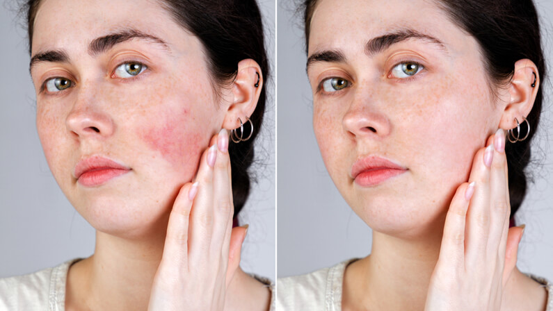 Rosacea Treatment before and after