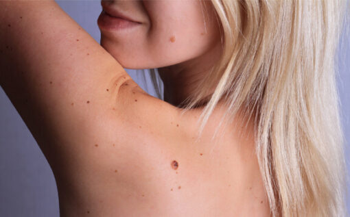moles