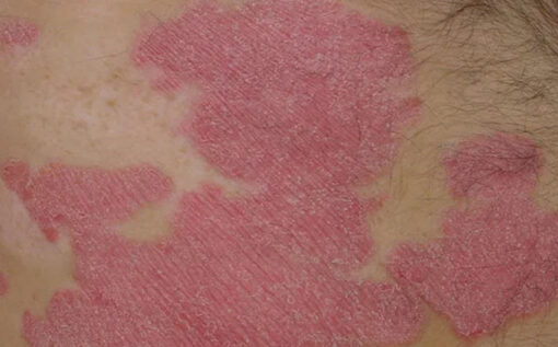 psoriasis