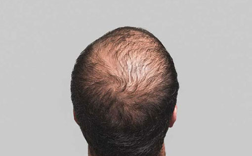 prp hair restoration