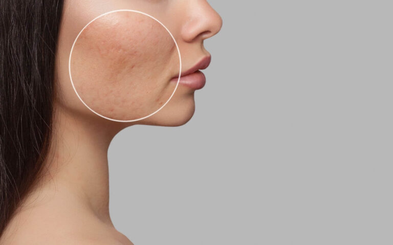 Profile view of a woman highlighting skin texture issues on her cheek, with a circular zoom on a specific area showing acne scars and uneven skin tone. The background is a muted gray, emphasizing the subject&apos;s features. This image is relevant for discussions on skincare, acne treatment, and dermatological health, illustrating common concerns faced by individuals.