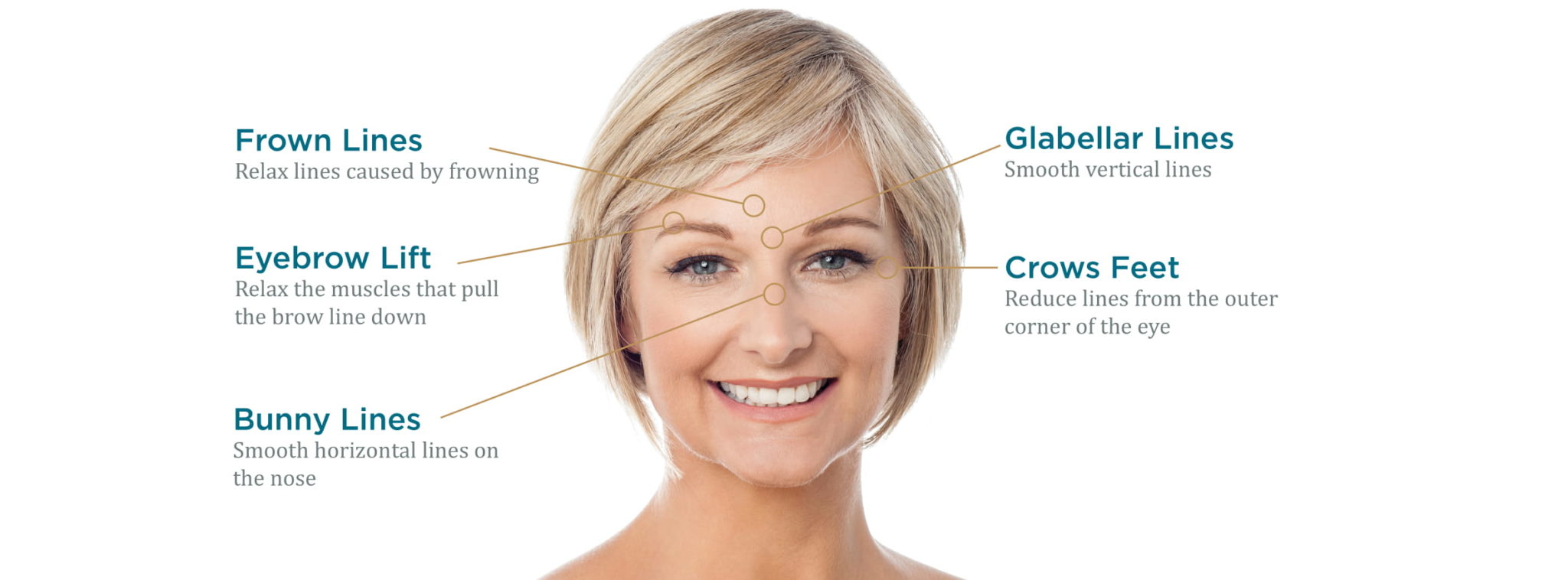 Dysport-botox