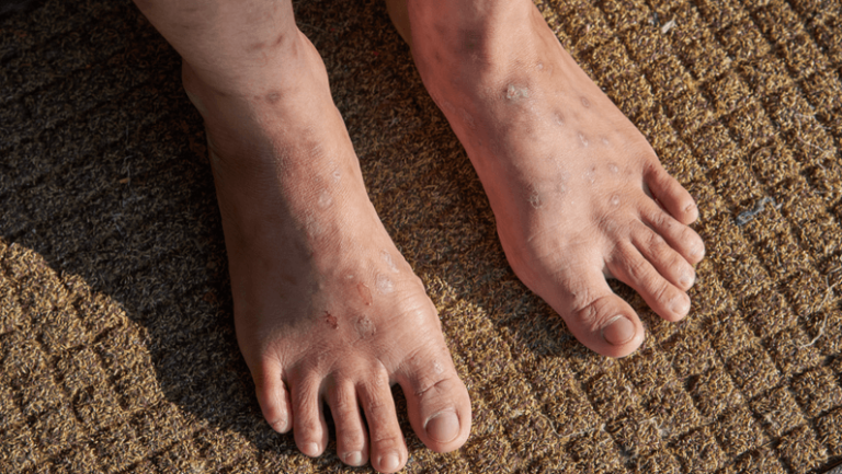 Fibrous Papule