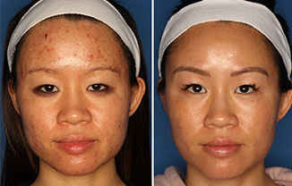 botox vs dysport