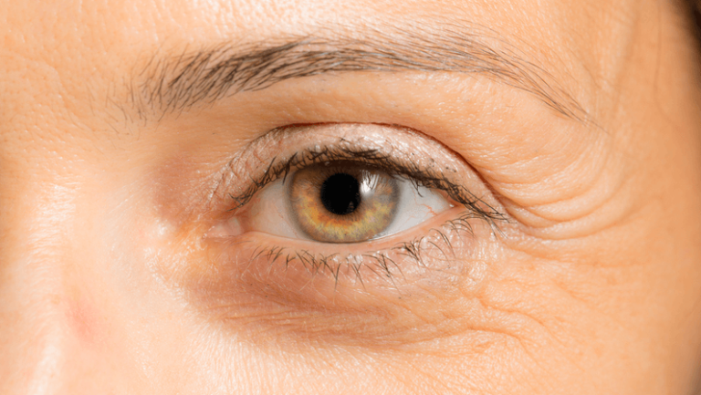 crows feet