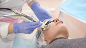 laser resurfacing