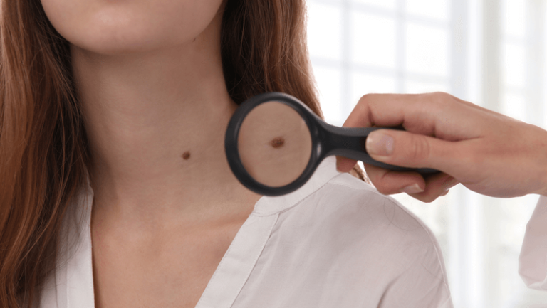 moles