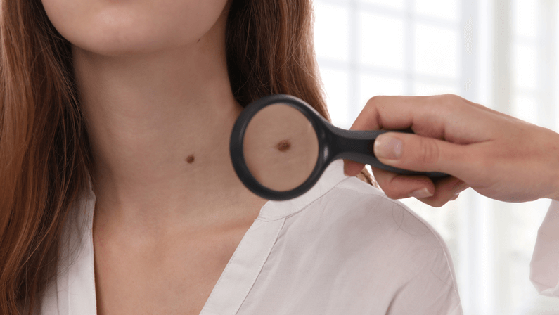 moles
