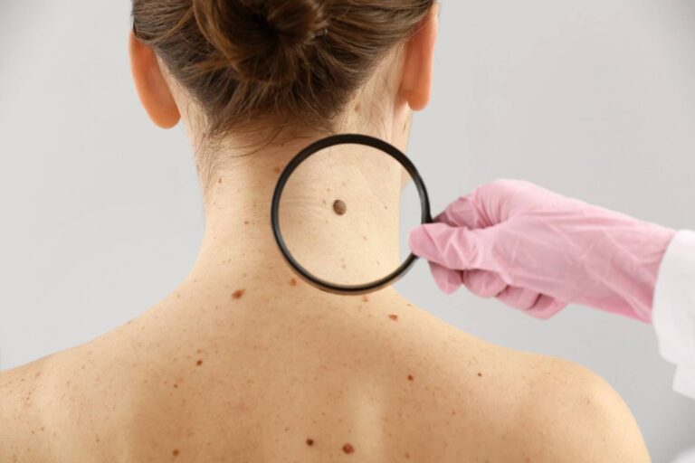 A healthcare professional wearing pink gloves examines a mole on the back of a woman&apos;s neck using a magnifying glass. The image highlights the importance of skin examinations for monitoring moles and skin health. Regular checks can help in the early detection of skin conditions, including melanoma. This visual serves as a reminder for individuals to be proactive about their skin health and consult a dermatologist for any concerns about changes in moles or skin appearance.
