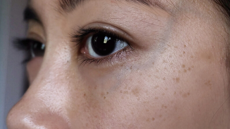 seborrheic keratosis