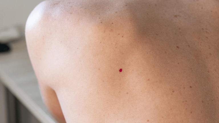 what is cherry angiomas