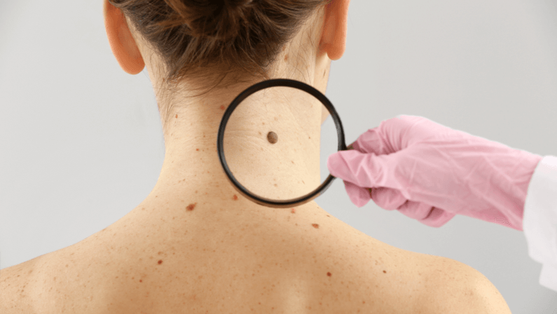 A magnified mole at the back of a lady
