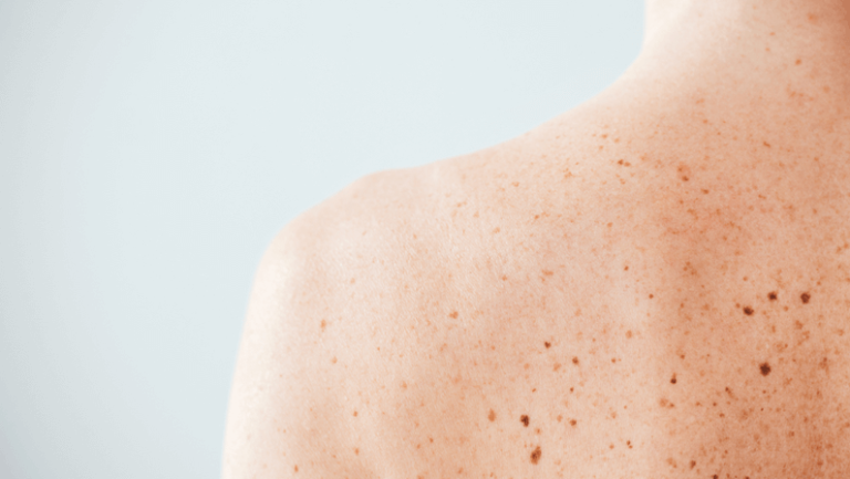 moles on the back of a lady