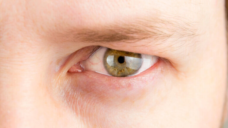 a person with Saggy eyelid
