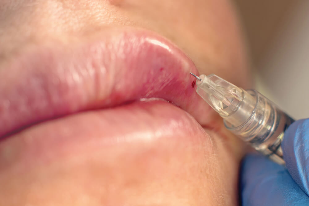 Dermal filler injection on lips