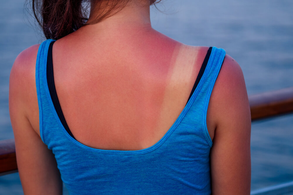 A young woman with sunburned skin on her back, wearing a blue tank top. The image shows distinct tan lines indicating areas protected by her clothing. The setting appears to be outdoors near water, suggesting exposure to sunlight. This visual highlights the importance of sun protection and the potential effects of UV rays on the skin, serving as a reminder for proper sun safety practices.