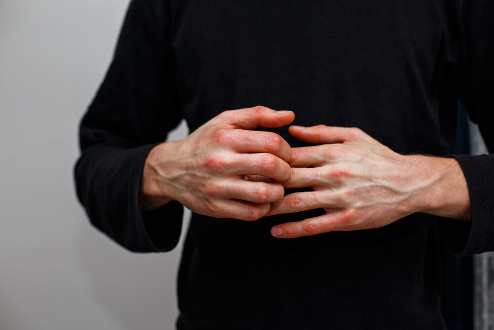 man with eczema on the hand