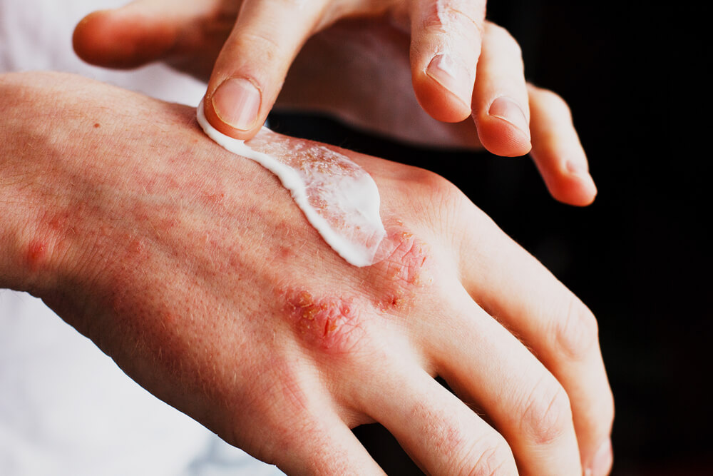 applying solution on eczema