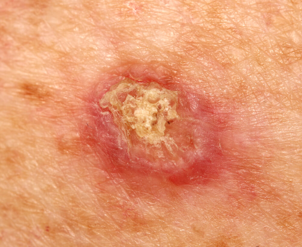 Close-up image of a skin lesion showing a raised, irregular surface with a yellowish crust and surrounding redness. This image may represent conditions such as infections, cysts, or other dermatological issues. Proper diagnosis and treatment from a healthcare professional are recommended for any concerning skin changes.