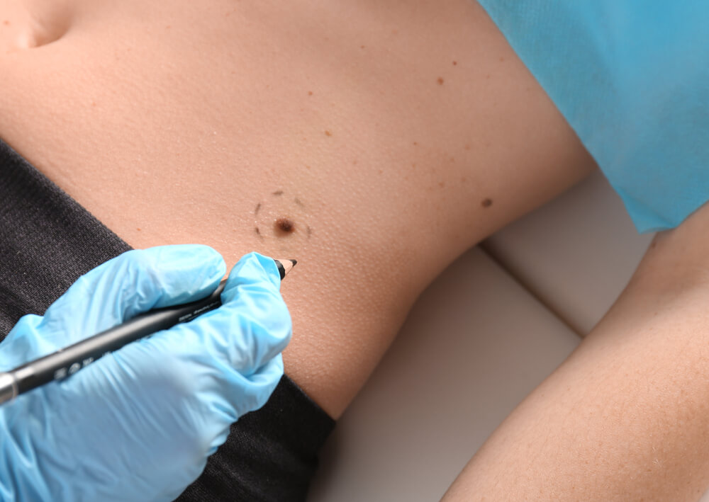 A close-up image showing a healthcare professional wearing blue gloves, marking a mole on a patient&apos;s abdomen with a black pen. The skin is light-toned and smooth, with the mole clearly visible. The setting appears to be a medical examination room, emphasizing the importance of skin checks for monitoring changes in moles. This image highlights the role of dermatological assessments in skin health and cancer prevention.