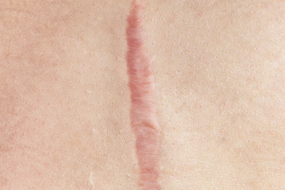 Close-up image of a skin scar, showcasing its raised texture and pinkish hue against a light skin tone background. The scar appears linear and slightly irregular, indicating a healing process. This image can be used to discuss topics such as scar healing, skin care treatments, or the emotional impacts of visible scars. It highlights the importance of understanding skin conditions and promotes awareness about scar management options.
