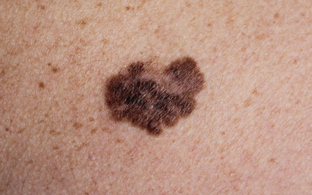 Close-up image of a mole on human skin, showing a dark brown irregularly shaped spot with varying shades. The surrounding skin is light brown with a smooth texture. This image can be used in discussions about skin health, mole examination, or dermatological conditions. It highlights the importance of monitoring skin changes for potential signs of skin cancer, such as asymmetry, border irregularity, color variation, diameter, and evolving characteristics.