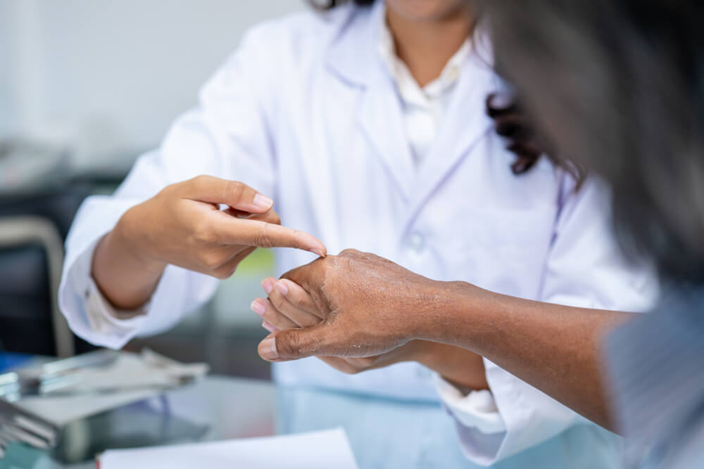 eczema patient