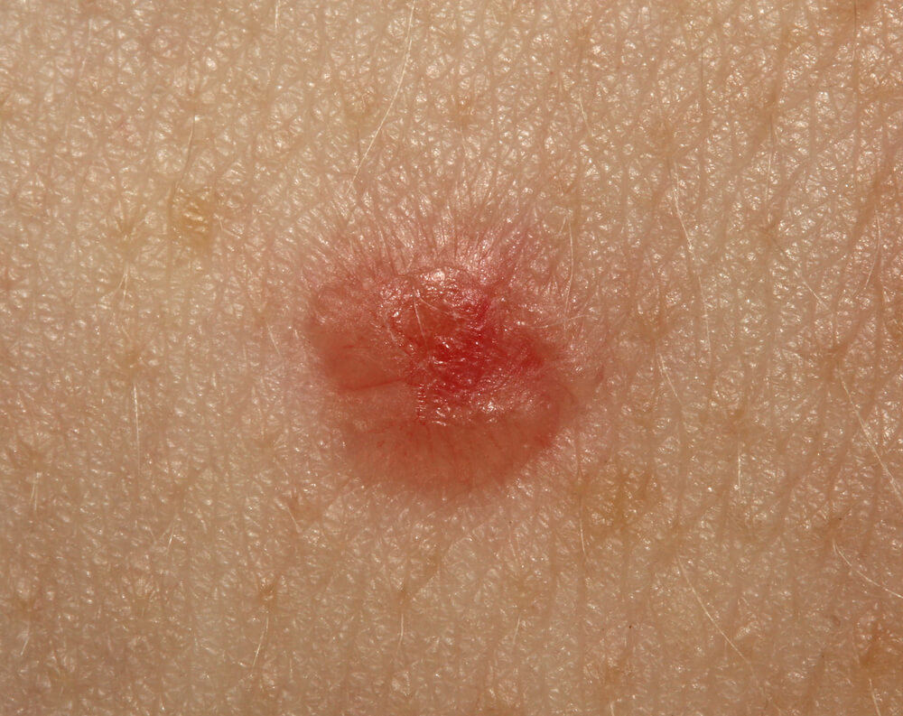 Close-up image of a red, inflamed skin lesion on human skin, highlighting textures and details of the surrounding area. The lesion appears slightly raised and has a shiny surface, indicating possible irritation or infection. This image can be used for educational purposes related to dermatological conditions, skin health awareness, or medical discussions about skin lesions and their treatment options.